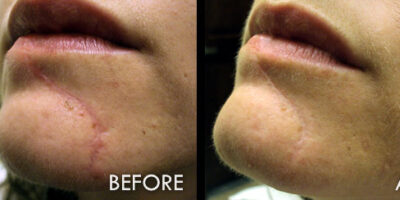 Scar Removal 2