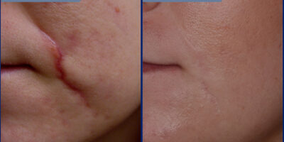 Scar Removal 3